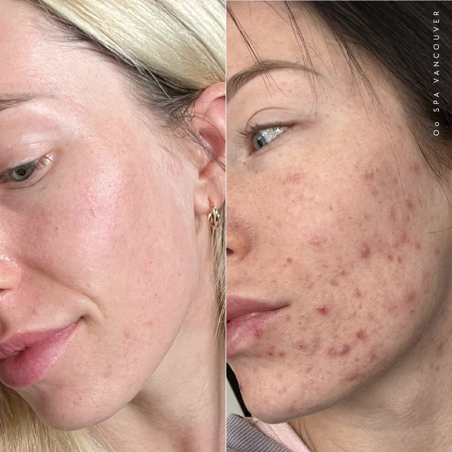 acne before after