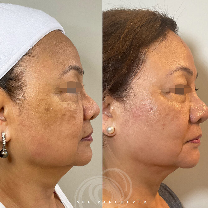 Before and after images showcasing a client's amazing transformation after the Luxe-Skin Anti-Aging Facial at Oo Spa, highlighting visibly reduced fine lines and enhanced radiance.