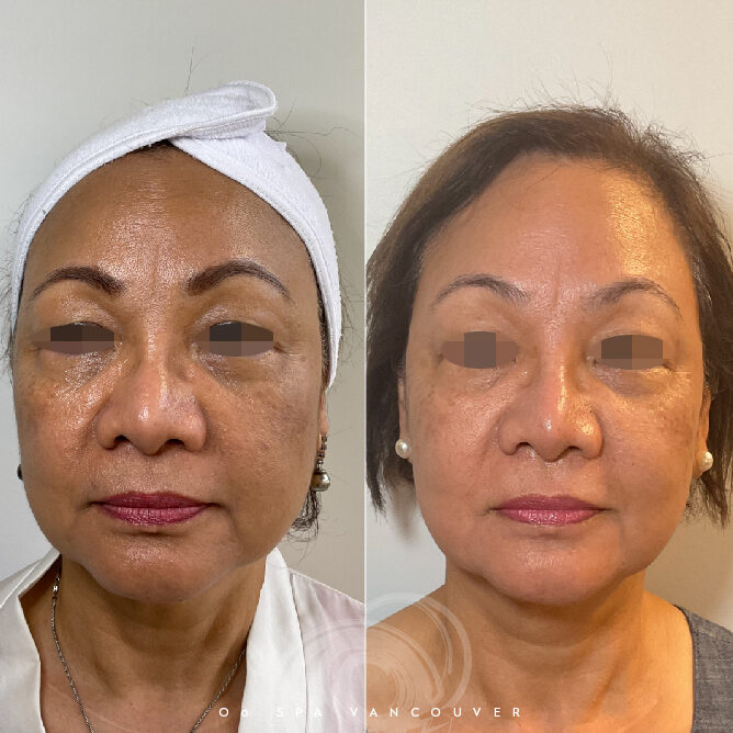 Before and after images of a client showcasing their skin transformation after the BioWarmy Facial Peel at Oo Spa, highlighting improved texture, reduced hyperpigmentation, and a radiant, youthful glow.